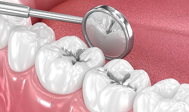 Amalgam Dolgular Değiştirilmeli mi?